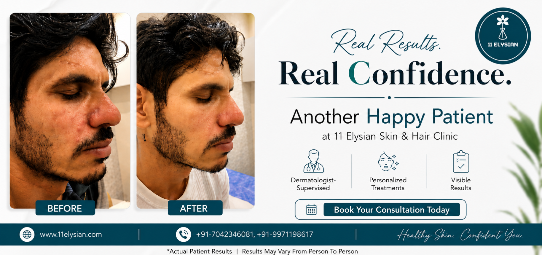 Acne Treatment Near Sector 100, Noida